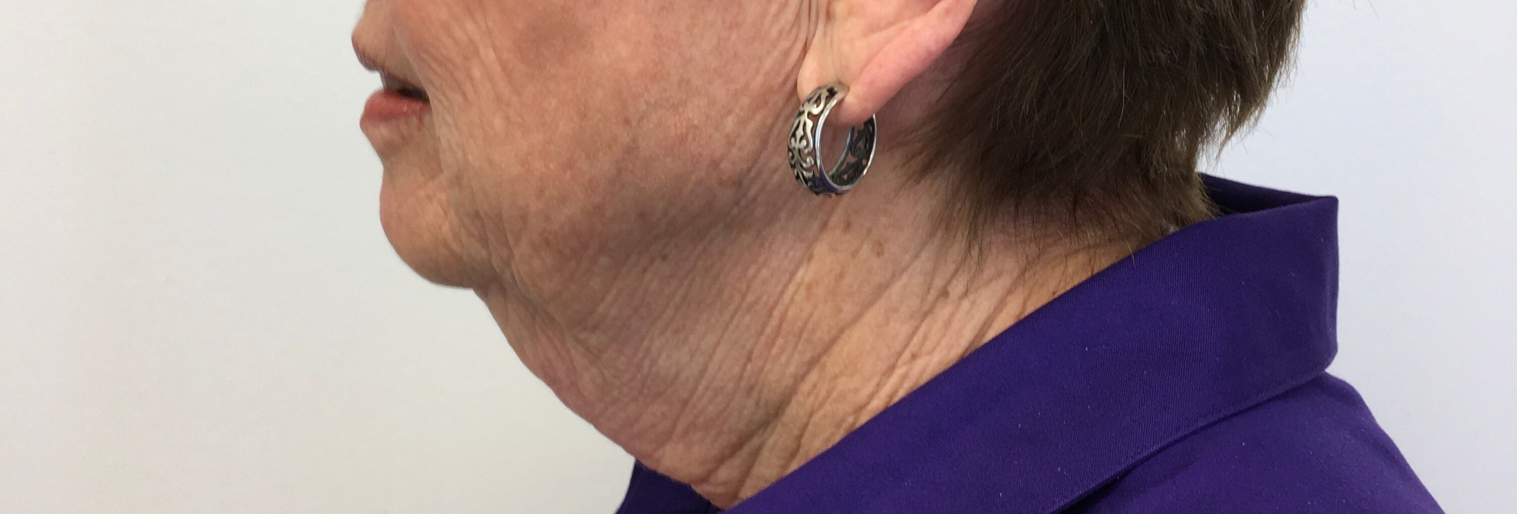 Neck Lift Before Neck Lift Before