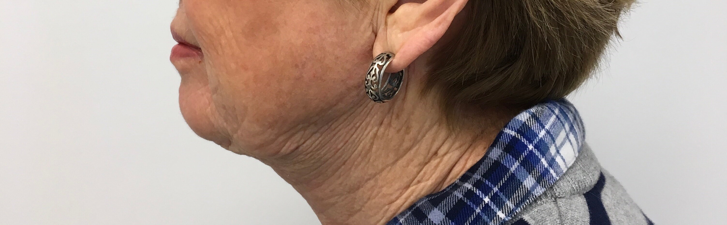 Neck Lift After Neck Lift After