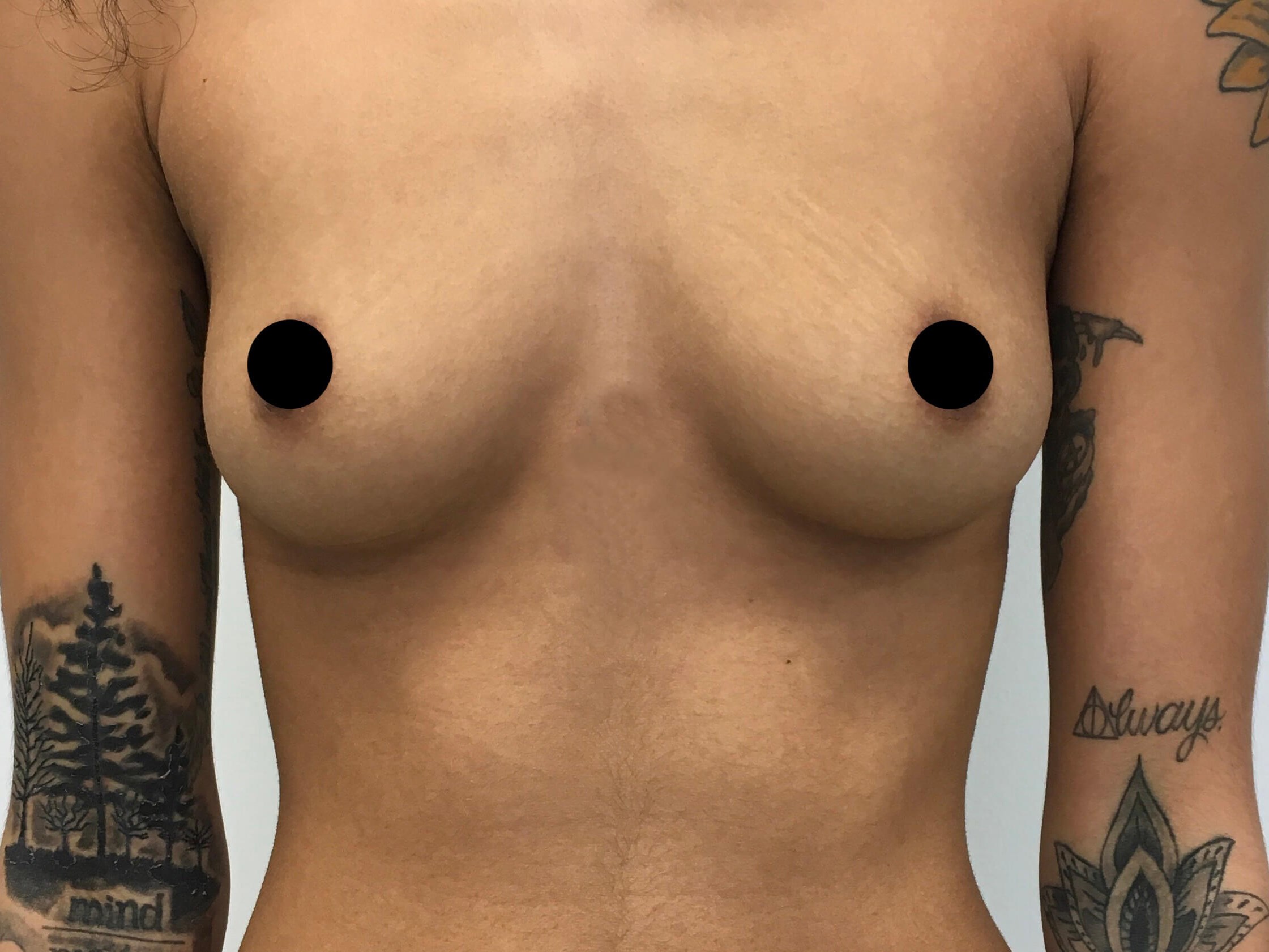 Breast Augmentation Before