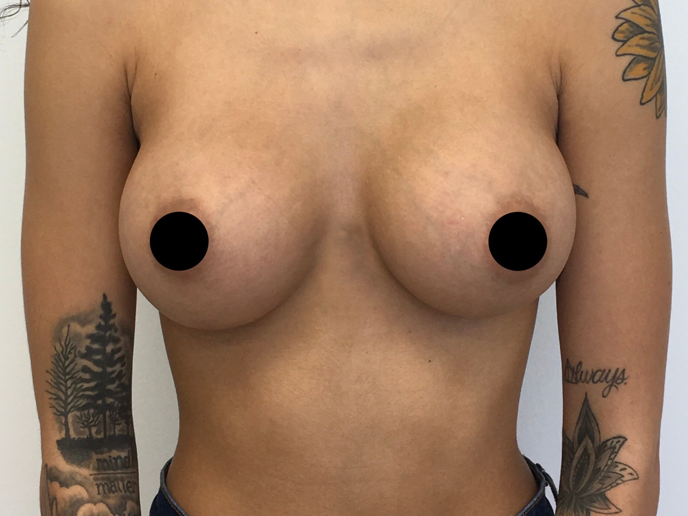 Breast Augmentation After