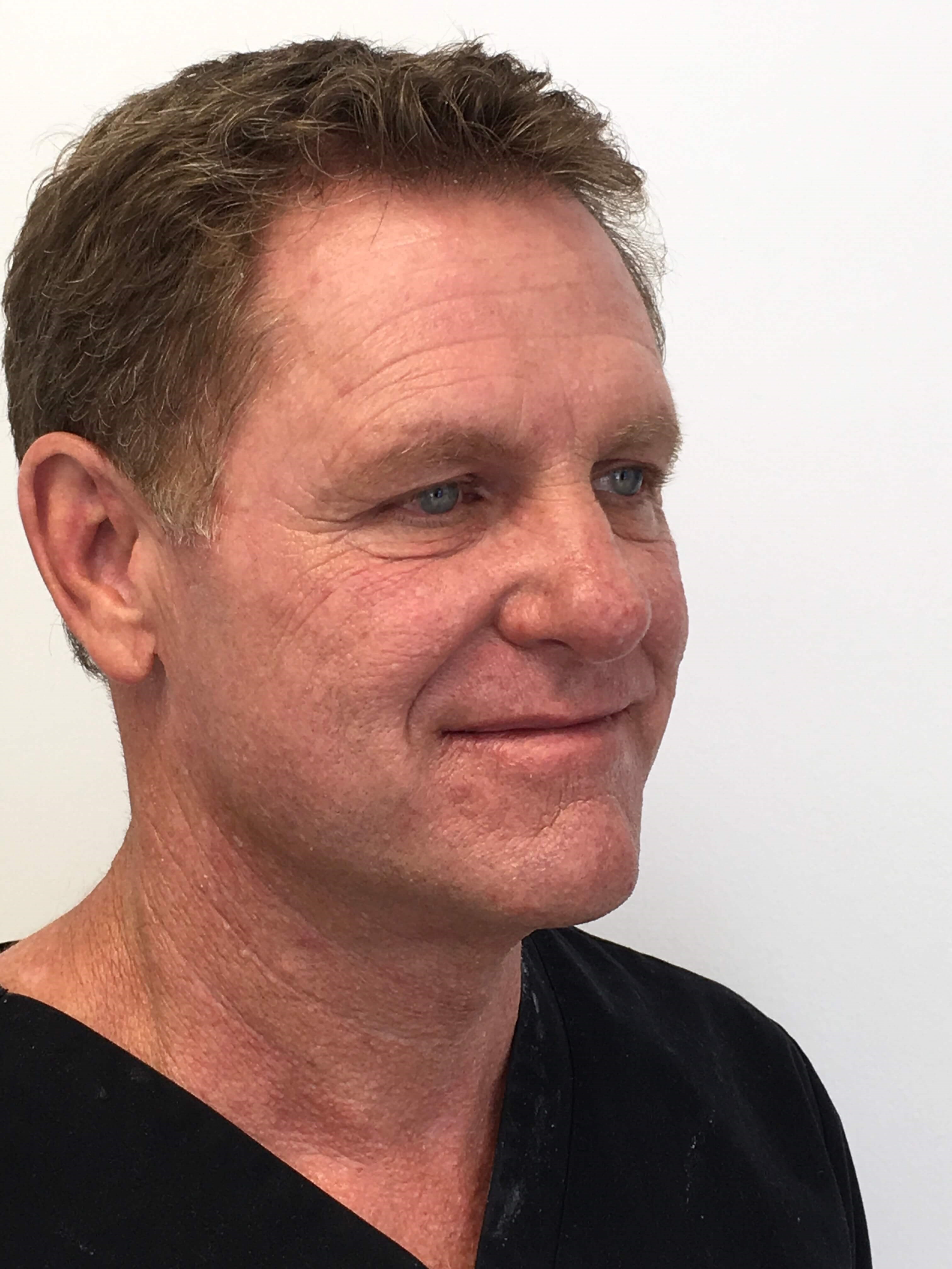 Lower Blepharoplasty Before