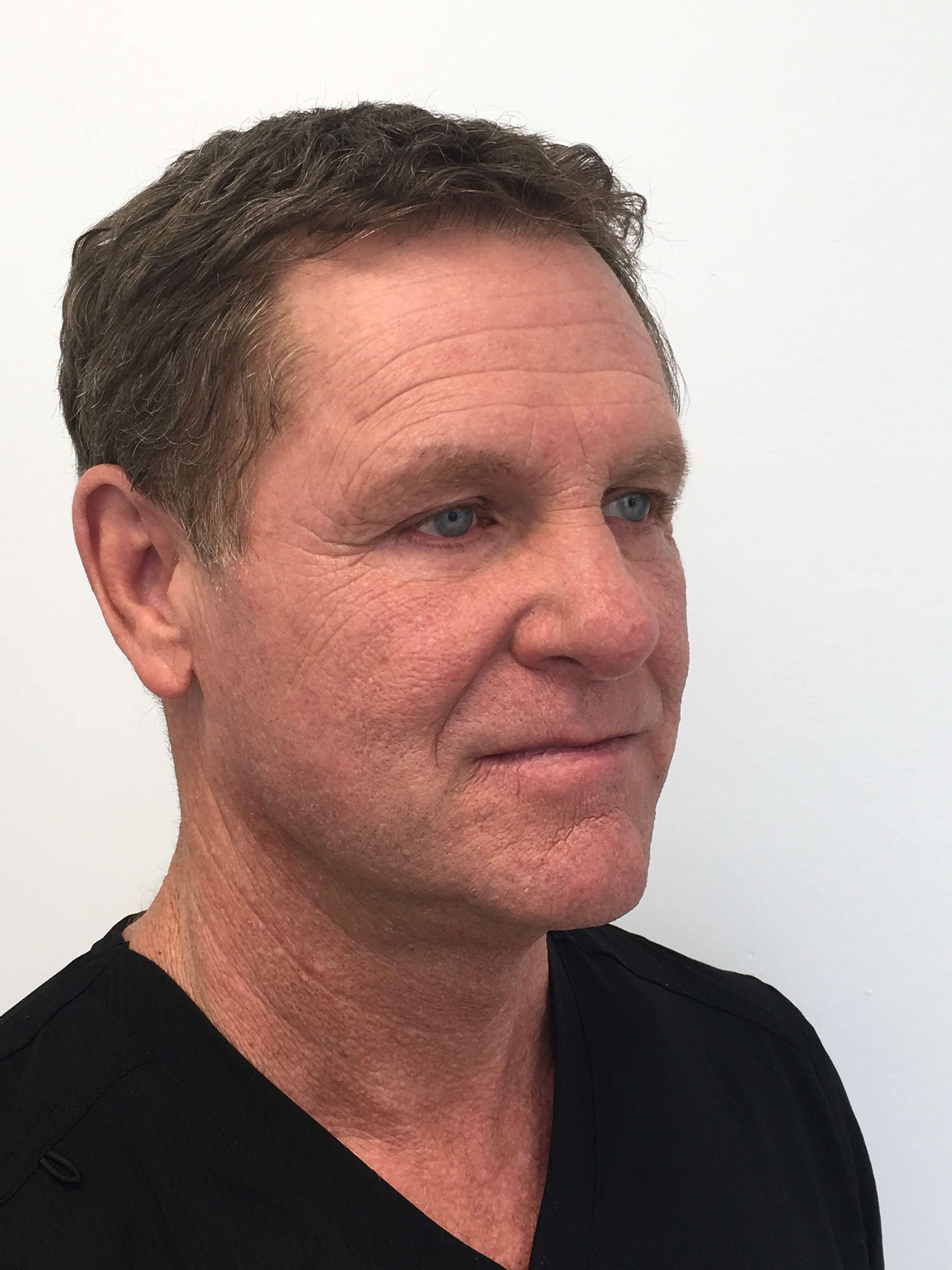 Lower Blepharoplasty After