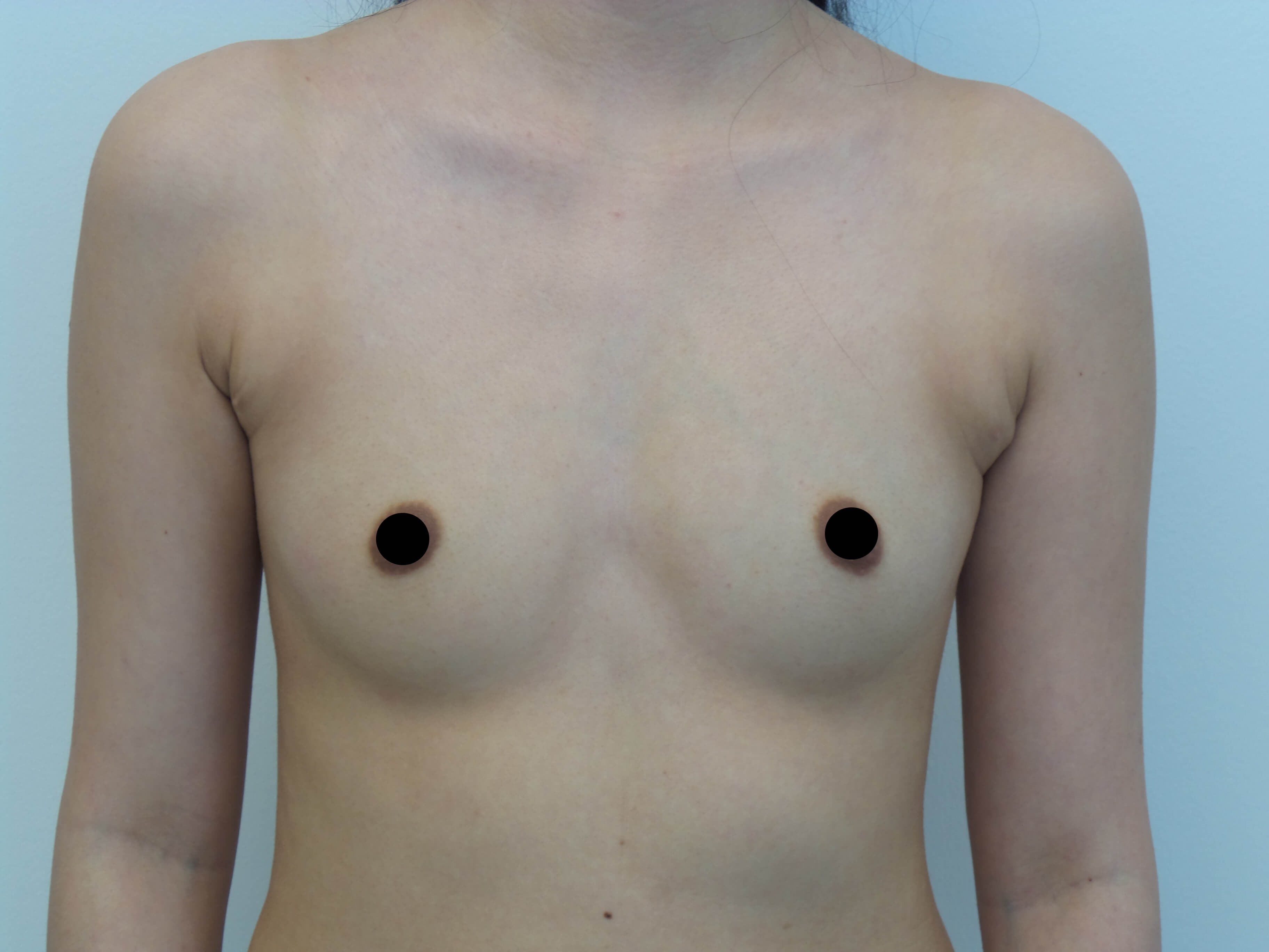 Breast Augmentation Before