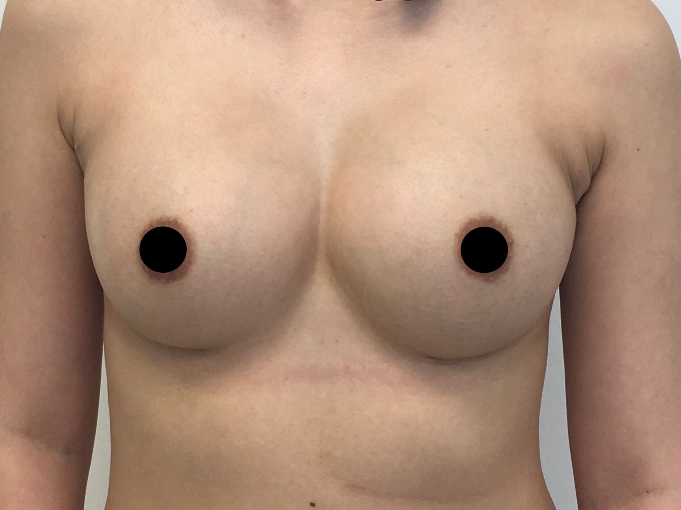 Breast Augmentation After