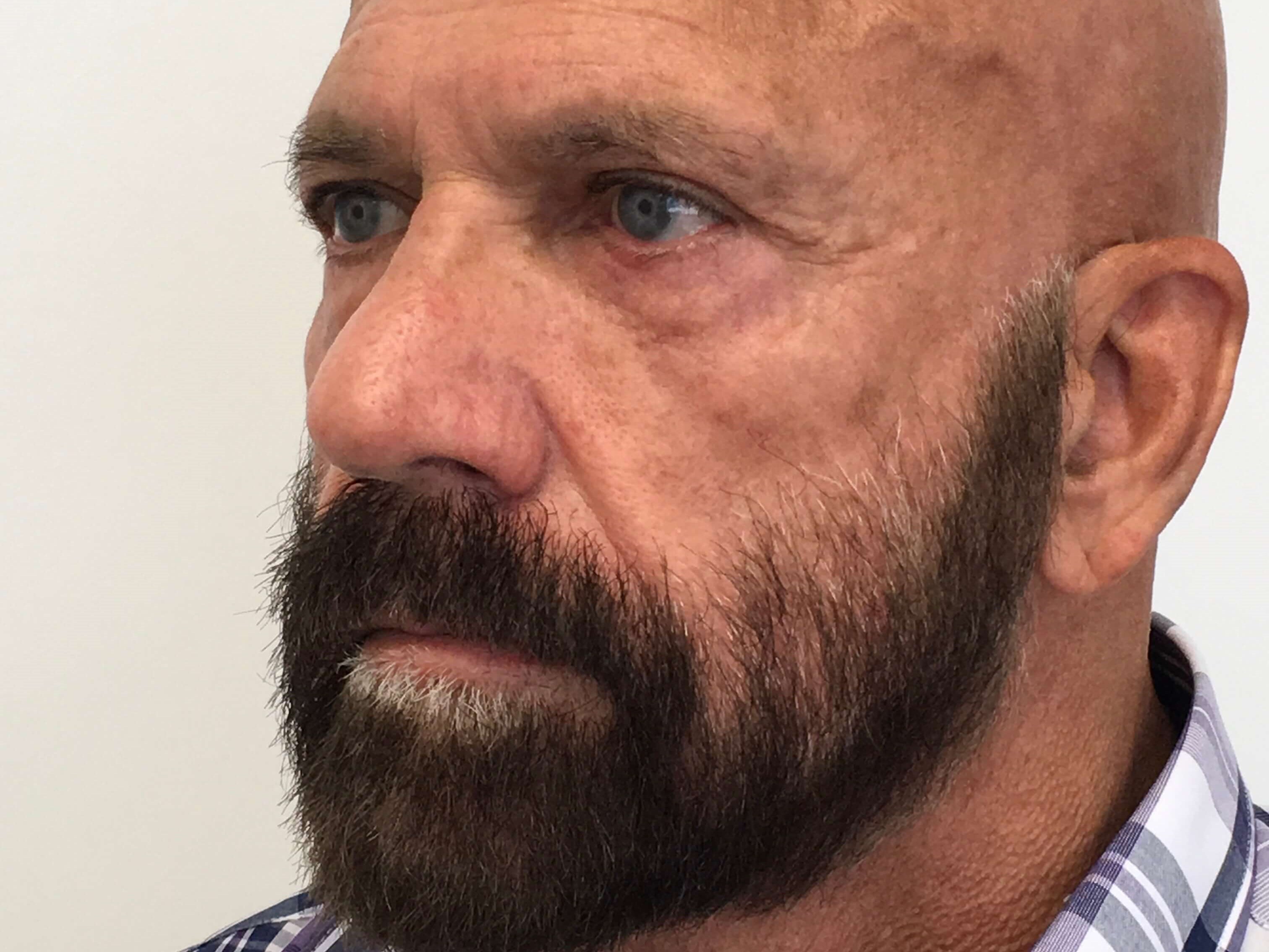 Blepharoplasty Before