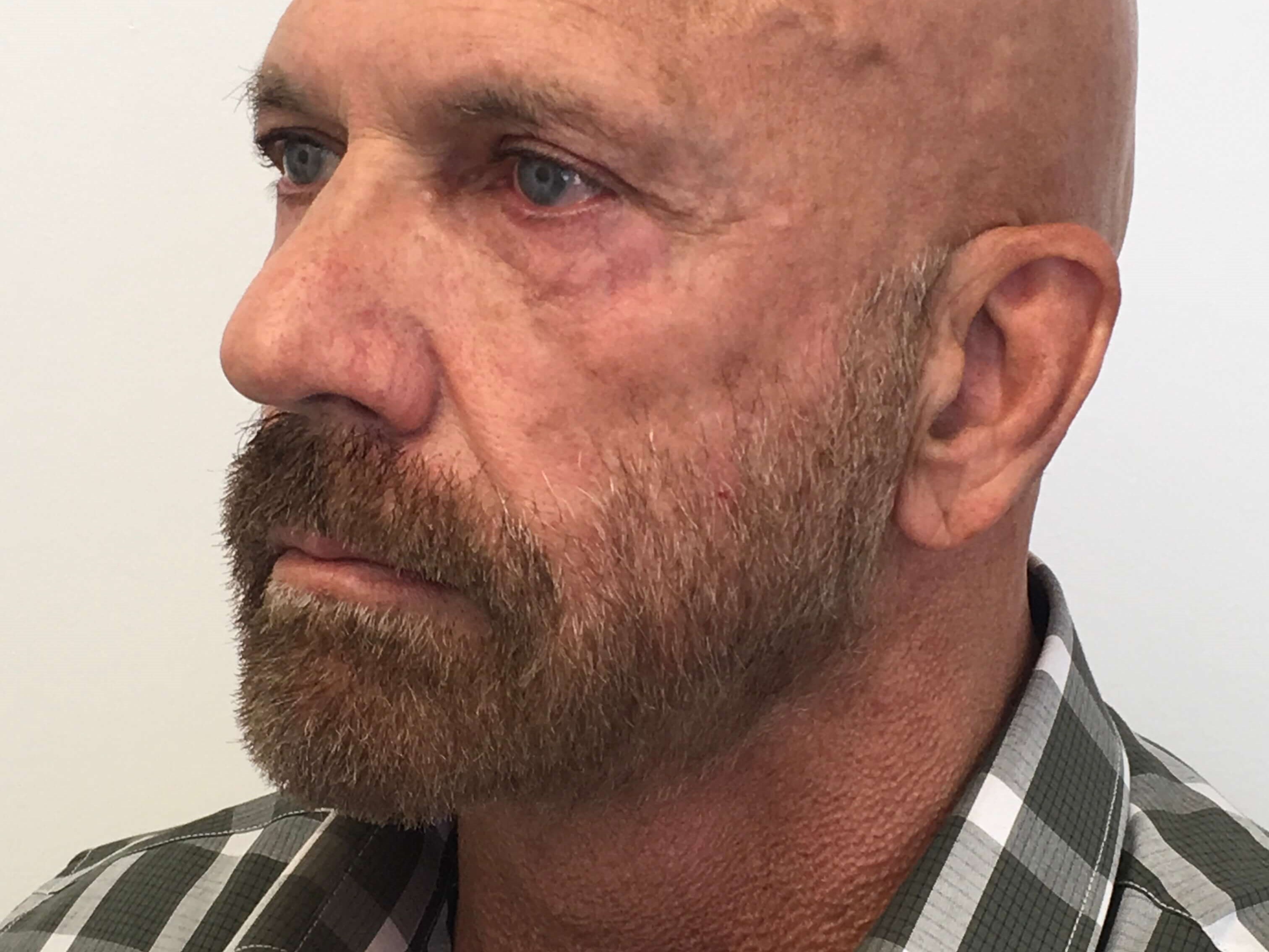 Blepharoplasty After