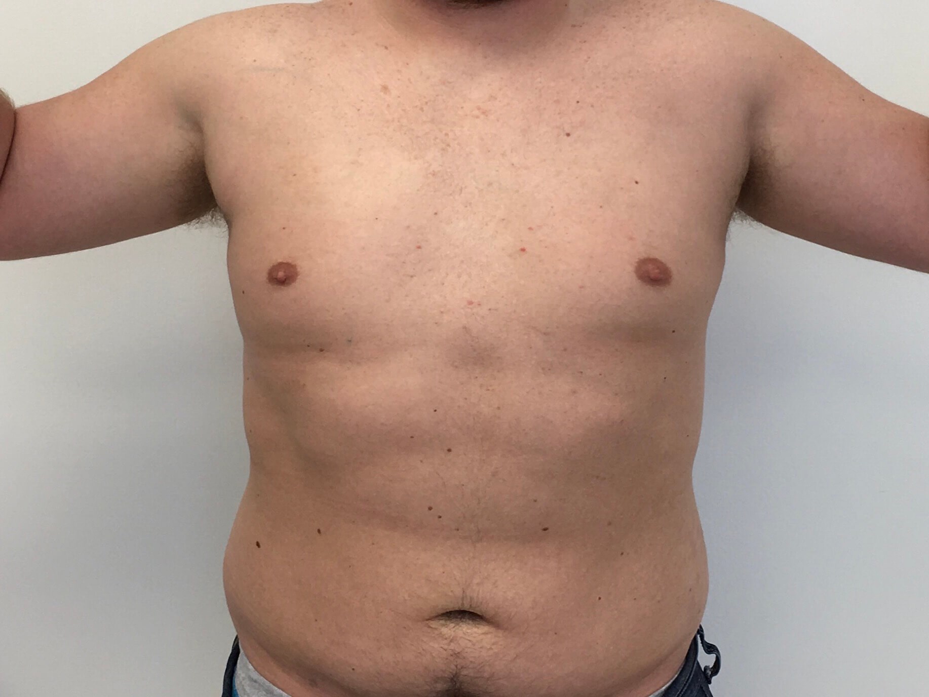 Liposuction - Trunk After