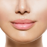 Lip Lift