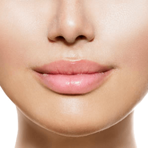 Lip Lift