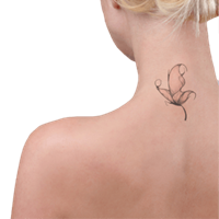 Laser Tattoo Removal